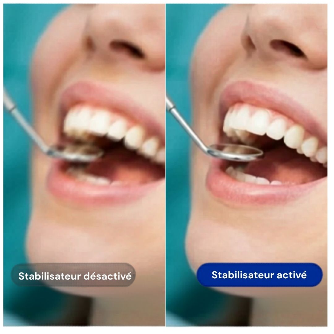 [locale:fr] Comparaison de la stabilisation d'image : désactivée vs activée — enregistrement dentaire plus net