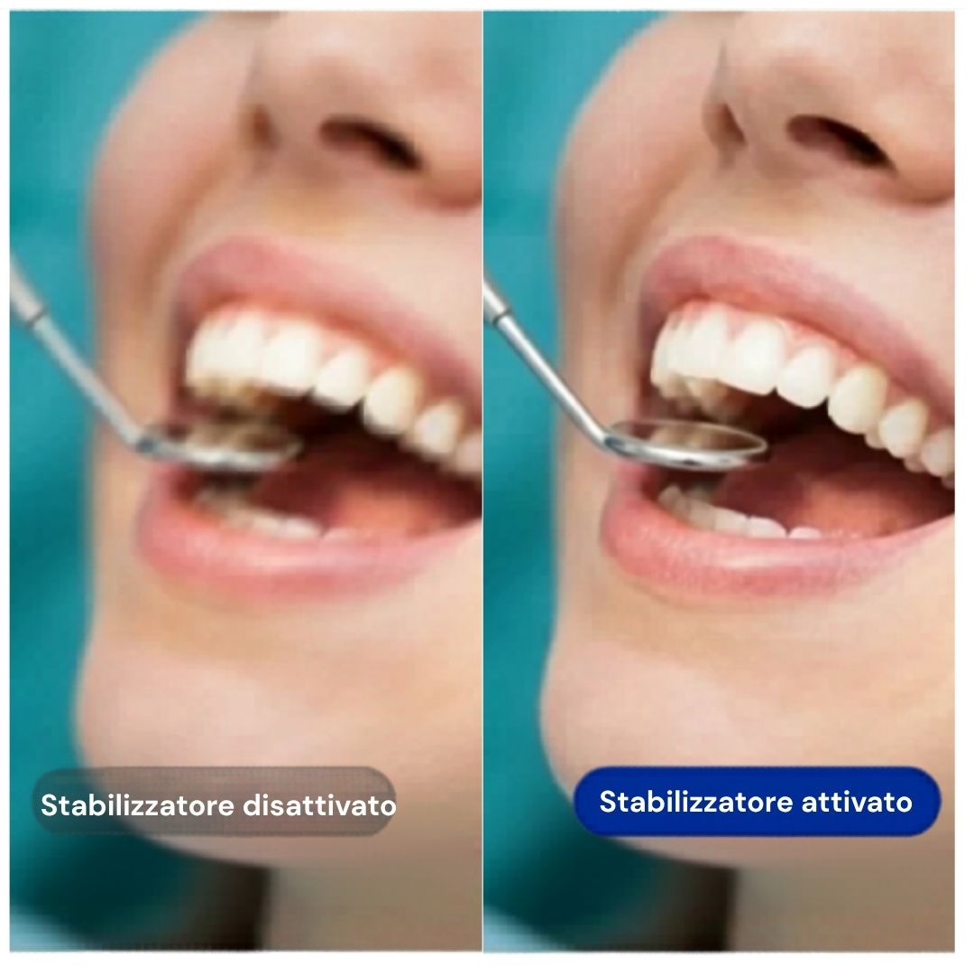 [locale:it] Confronto della stabilizzazione dell'immagine: disattivata vs attivata — registrazione dentale più nitida
